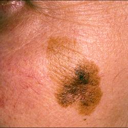 Example of skinCancerAndMelanomas
